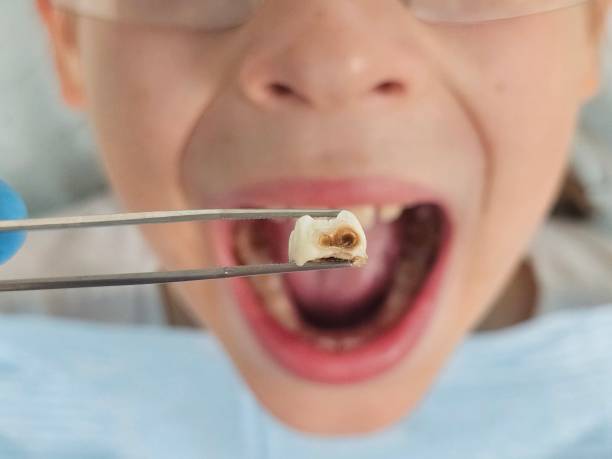 Best Emergency Tooth Extraction in Orida Ridge, FL